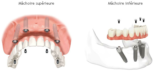 ALL-ON-4 PROTHESE SUR IMPLANT DENTAIRE